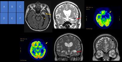 Case Report: Late-Onset Temporal Lobe Epilepsy Following Subarachnoid Hemorrhage: An Interplay Between Pre-existing Cortical Development Abnormality and Tissue Damage